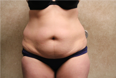 Tummy Tuck with Liposuction before