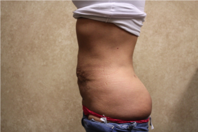Tummy Tuck with Liposuction before