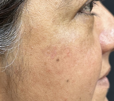 IPL Laser after