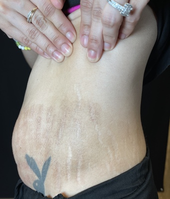 Combined Therapies after