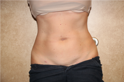 Liposuction  after