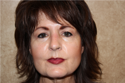 Rhinoplasty after
