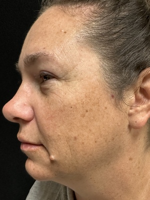 IPL Laser before
