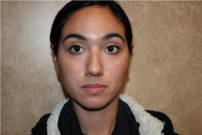 Rhinoplasty before