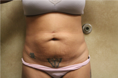 Tummy Tuck with Liposuction before