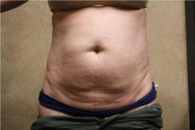 Tummy Tuck with Liposuction before