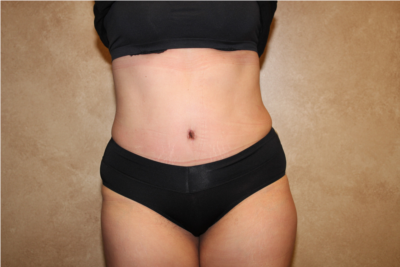 Tummy Tuck with Liposuction after