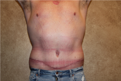 Extended Tummy Tuck with Liposuction after