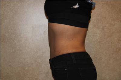 Tummy Tuck with Liposuction after