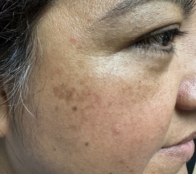 IPL Laser before