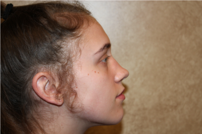Rhinoplasty before