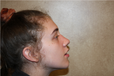 Rhinoplasty after