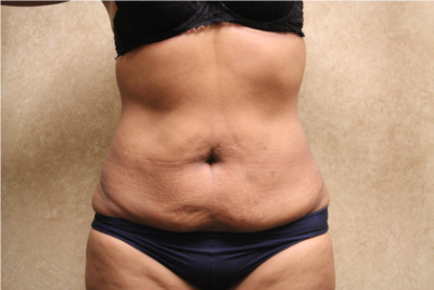 Extended Tummy Tuck with Liposuction before