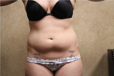 Liposuction  before