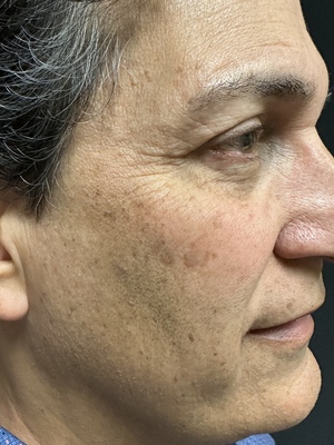 IPL Laser before