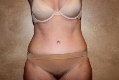 Tummy Tuck with Liposuction after