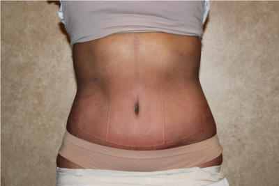 Extended Tummy Tuck with Liposuction after