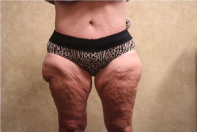 Tummy Tuck after