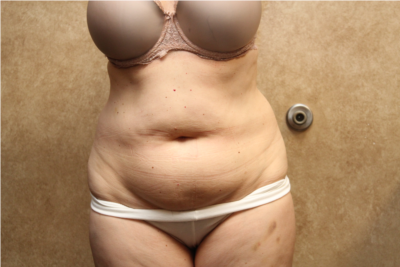 Liposuction  before