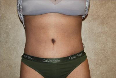 Tummy Tuck with Liposuction after