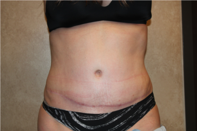 Tummy Tuck with Liposuction after