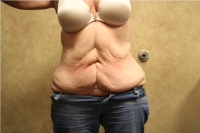 Tummy Tuck before