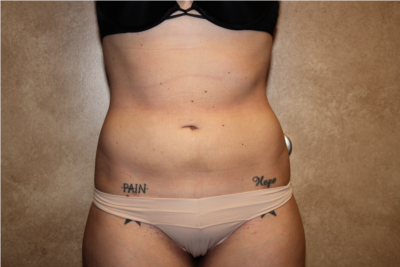 Liposuction  after