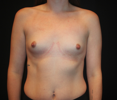 Silicone Breast Augmentation before