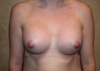 Silicone Breast Augmentation after